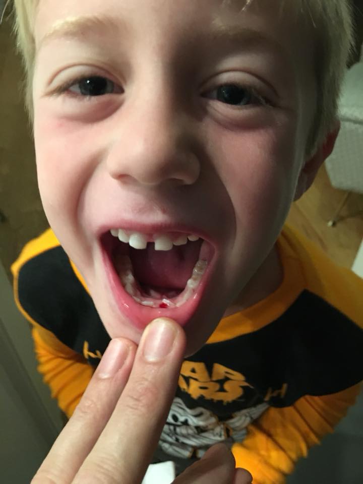 Hudson's_second_tooth_gone.jpg